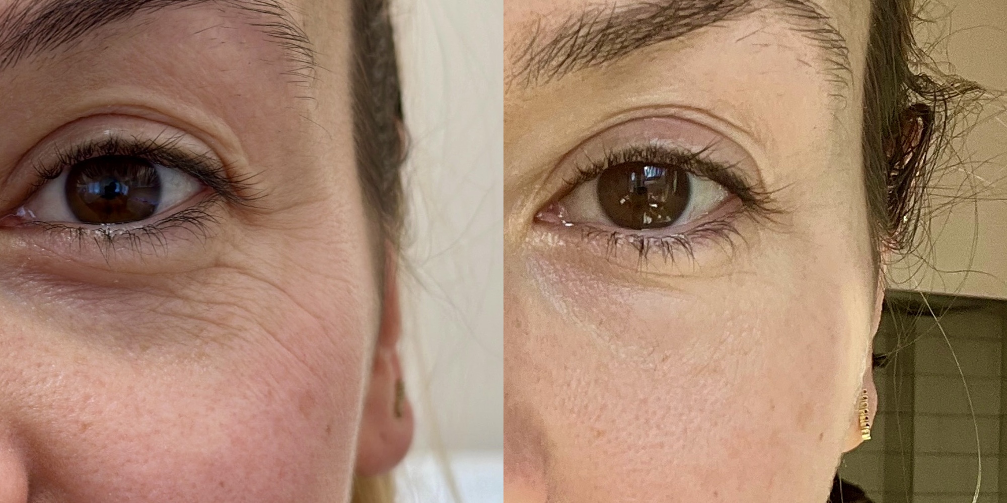 Close-up of a client's eye area before and after Micro Glow microneedling treatments.