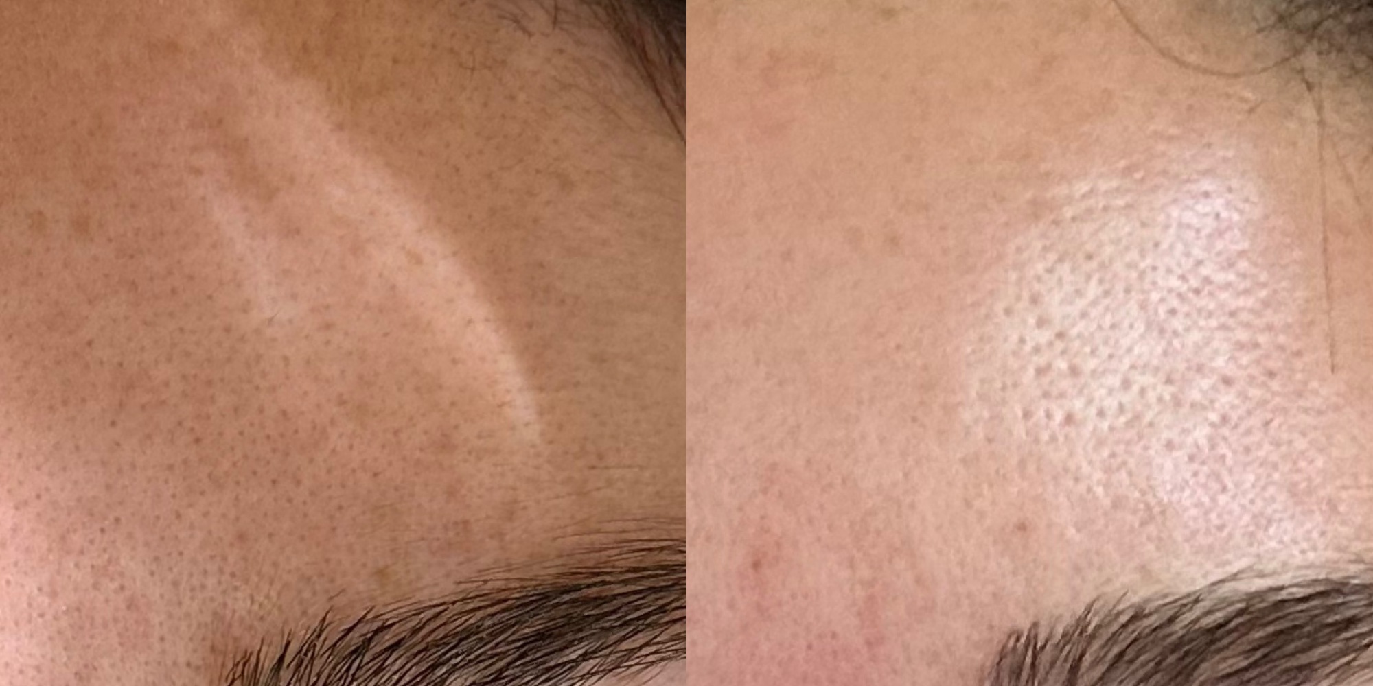 Close-up of a client's brow area before and after one Micro Glow microneedling treatment.